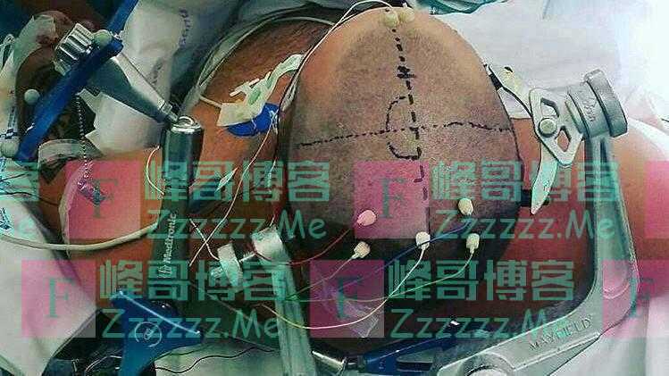 假如华佗真的给曹操“开颅”,会是什么结果?专家:当场去世!