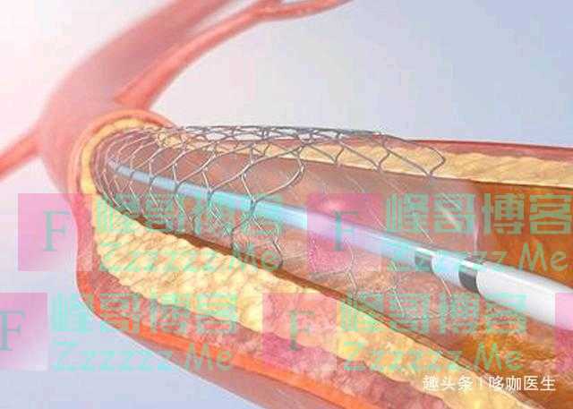 美国已经不放支架了，中国用的支架都是美国淘汰的？