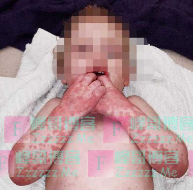 英国众多幼童爆发紫色皮疹，卫生部长：紧急研究是否为新冠新症状