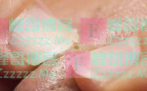 鼻子捏出黄白色油乎乎的“油条儿”出来，是什么？该怎么办