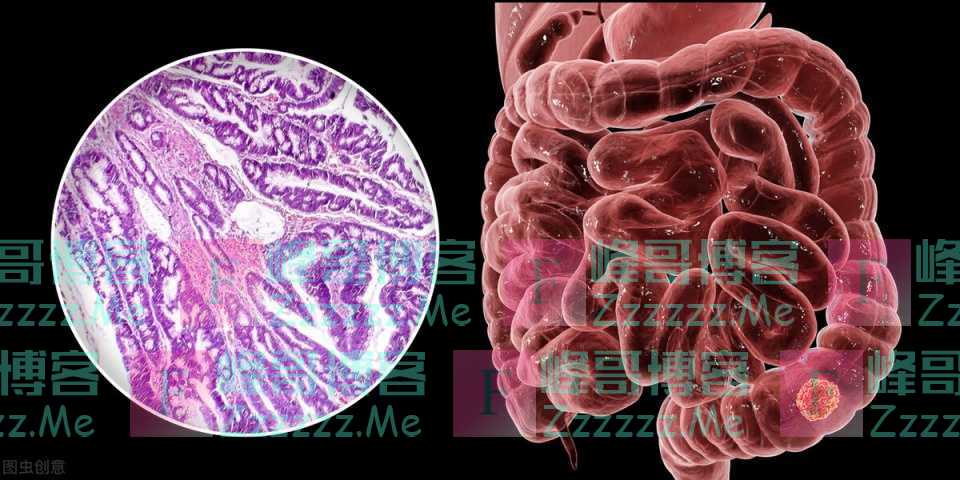 因害怕肠镜，39岁经理遗憾终身——97%的肠癌患者，从没做过肠镜