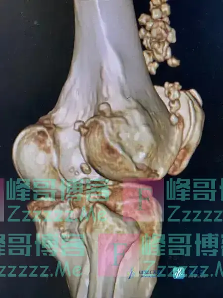 膝关节内捉到一群“小老鼠”，整整36只