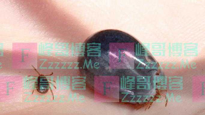 天气炎热、蜱虫活跃，警惕蜱虫引起的传染病