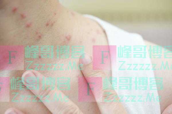 荨麻疹反复发作，或与这5个因素有关，找出病因，才能有效控制
