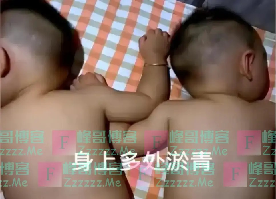 双胞胎肚内打架，出生后浑身淤青，专家：这种情况几乎不可能