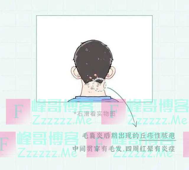 头皮上的“白色颗粒”是什么？漫画告诉你，管不住手的下场会怎样