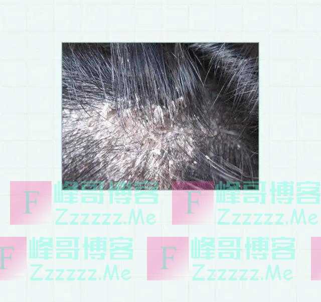 头皮上的“白色颗粒”是什么？漫画告诉你，管不住手的下场会怎样