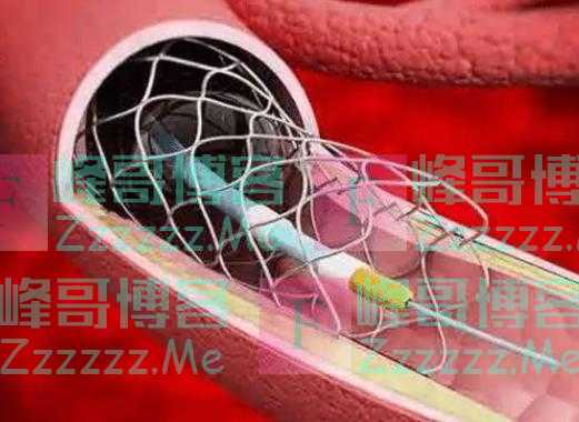 装上心脏支架后，还能活多少年呢？医生不再隐瞒，请提前告诉家人