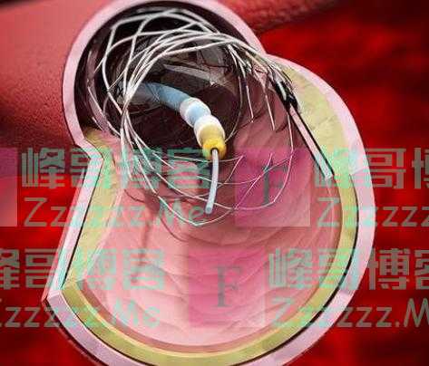 装上心脏支架后，还能活多少年呢？医生不再隐瞒，请提前告诉家人