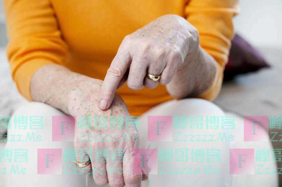 为何有些人满脸“老年斑”，有的却干干净净呢？医生说出实情