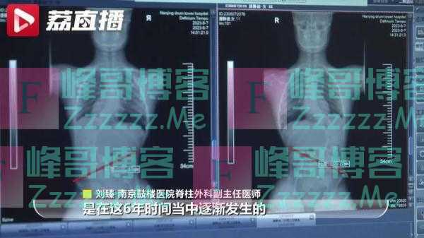 这个动作或致瘫痪！一医院仅3周已接诊5例，医生提醒→