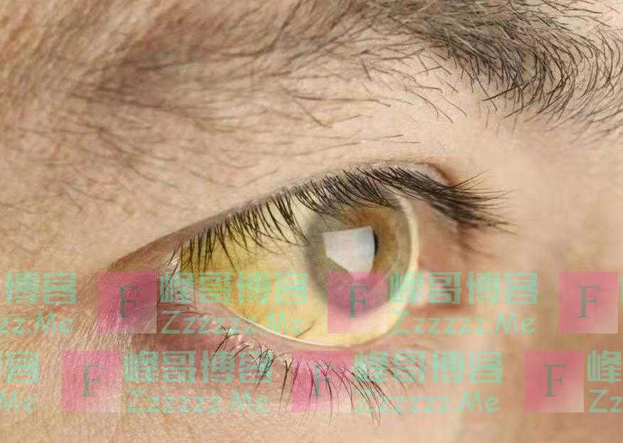 大蒜是肝病的“发物”?医生:想肝好,忌3物,吃2果,肝或感激你