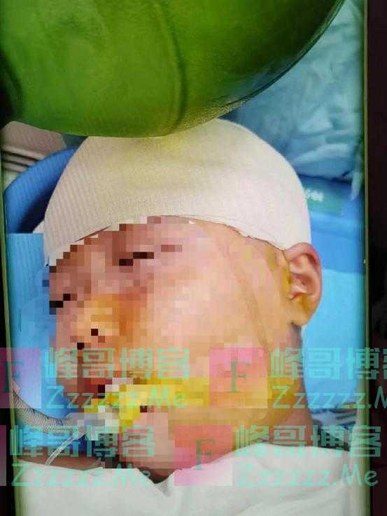 被老师打破头骨的9岁女生仍在ICU！家长发声：他本想打孩子身后的同学