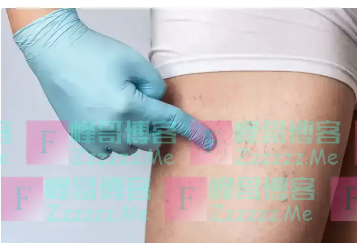 “血栓大户”被揪出!再次提醒:劝你少吃4种食物,越吃血管越堵