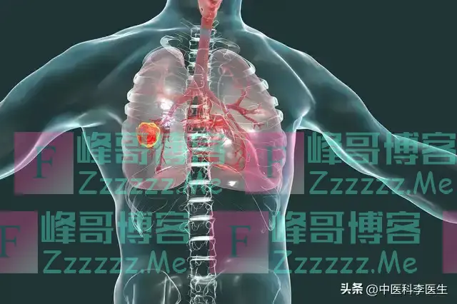 肺癌早期信号，不是咳嗽，也不是胸闷，有4个很容易忽视的症状